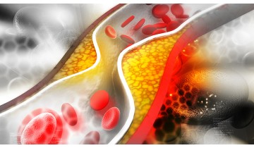 Cholesterol Management
